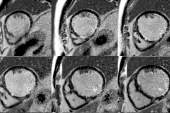 Viability Testing Fails to Find HF Patients Who’d Benefit From PCI in REVIVED-BCIS2 